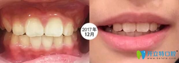 8歲的兒子在成都河馬口腔做矯正6個月