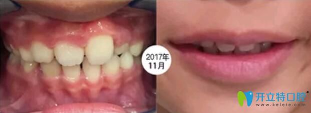 孩子在成都河馬口腔做矯正第4個月