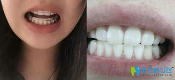 濟南韓氏口腔金屬牙套矯正術后效果很贊