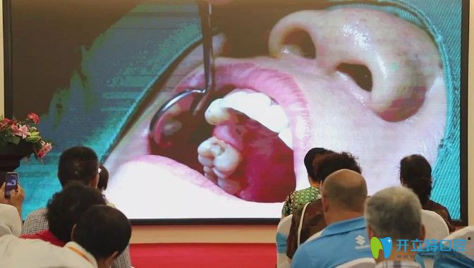 天津中諾口腔立得用種牙手術圖