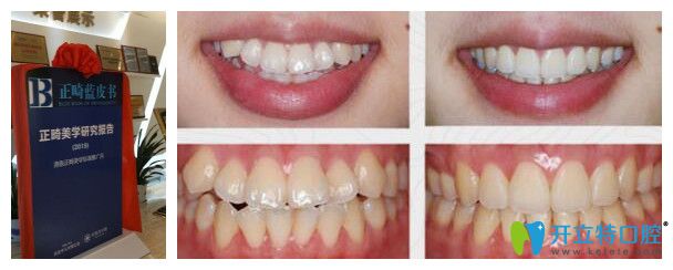 好佰年口腔正畸藍皮書和案例