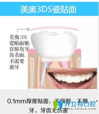 杭州美奧口腔3DS瓷貼面修復