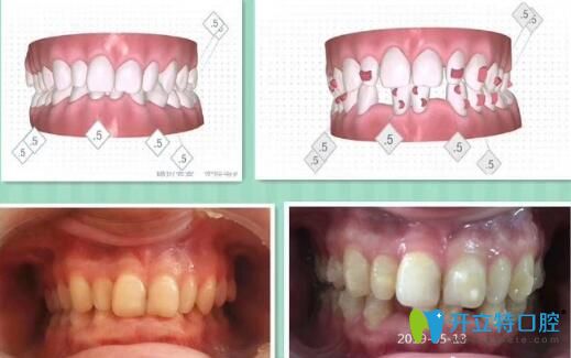 瑾帆口腔深覆合隱形矯正案例前后效果對比圖