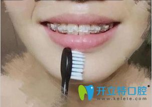 在東莞壹加壹口腔做陶瓷托槽矯正牙齒11個(gè)月效果