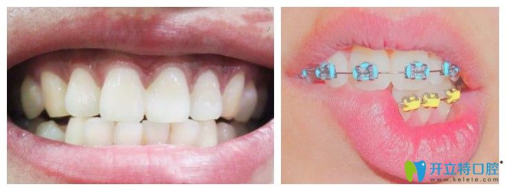 成都圣貝口腔炫彩牙套矯正案例