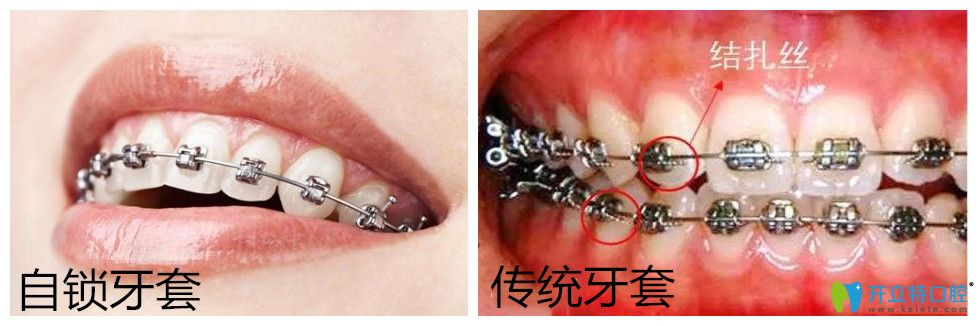 自鎖托槽牙齒矯正多少錢？正畸國產(chǎn)與進口自鎖有區(qū)別嗎?