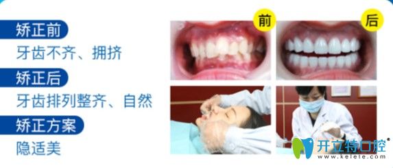 廣州曙光口腔牙齒不齊矯正案例