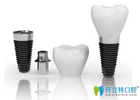 昆明尚愛(ài)韓美口腔李滿坡醫(yī)生介紹種植牙