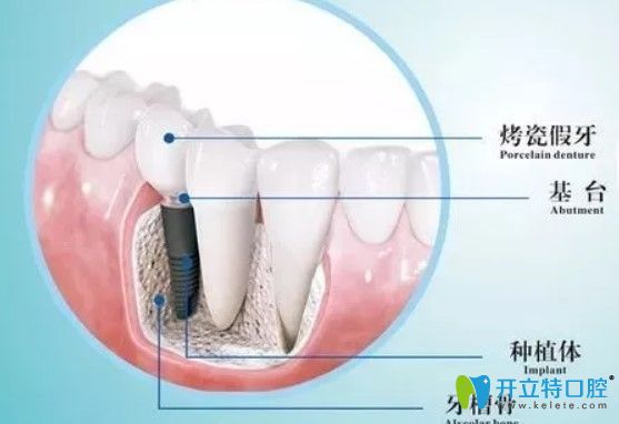 維樂口腔種植牙是由基臺、種植體組成圖示