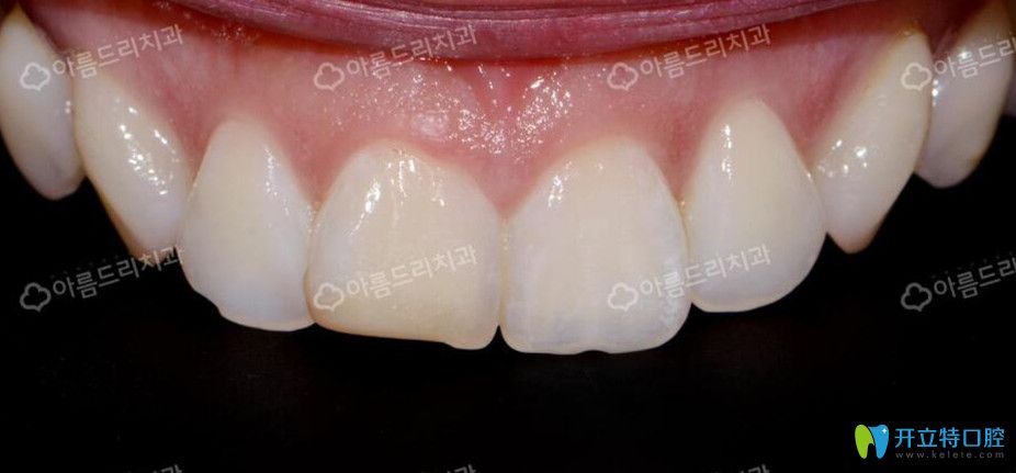 韓國(guó)安特麗做牙貼面前牙齒情況