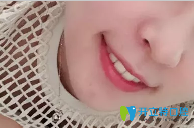 牙齒矯正可以做兩次，正畸效果是美好的