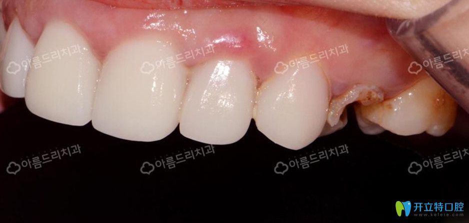 去韓國(guó)安特麗做后牙種植前