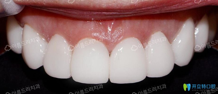 韓國(guó)安特麗牙貼面后效果圖