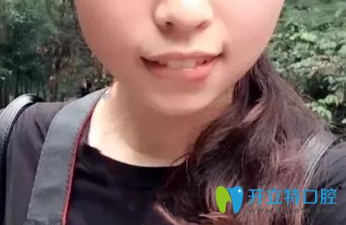 這是我之前做過牙齒矯正反彈后的牙齒照