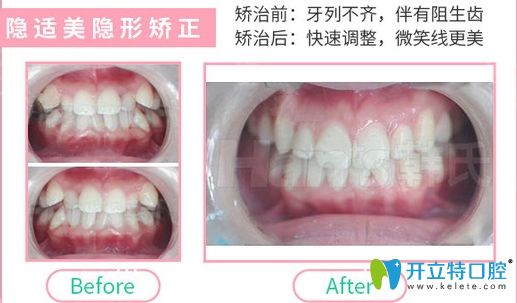 濟(jì)南韓氏口腔隱形牙齒矯正效果