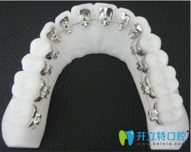 南昌輝煌口腔丁圣剛介紹舌側(cè)牙齒矯正技術優(yōu)勢