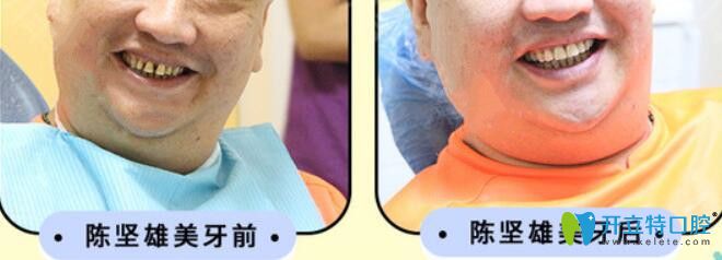 陳先生采用瓷貼面修復發(fā)黃牙齒案例