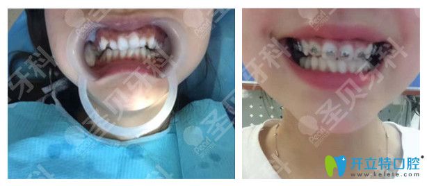 圣貝咬合問題矯正案例圖示