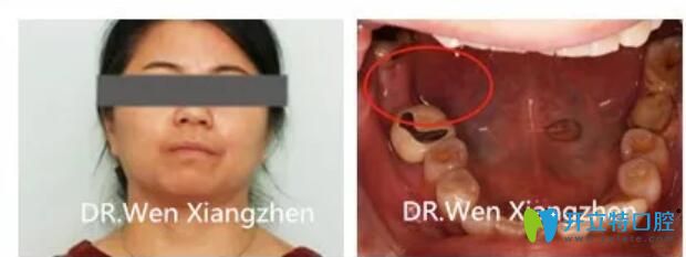 震驚！林阿姨在湖州鼎植口腔做了一顆種植牙價格才2500元