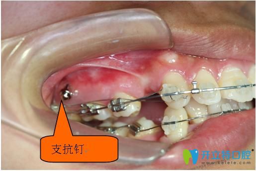 南昌輝煌口腔廖正宇醫(yī)生介紹種植支抗釘注意事項(xiàng)