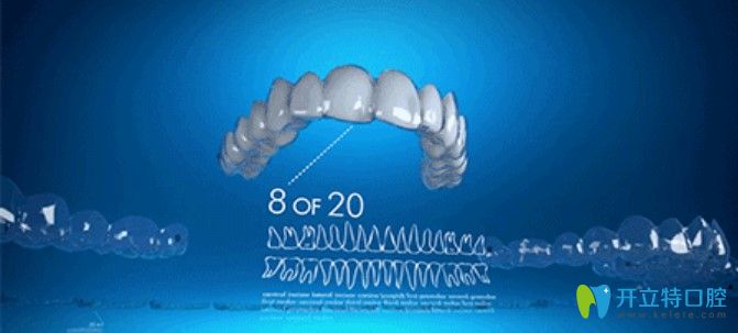諾德口腔矯正效果圖示