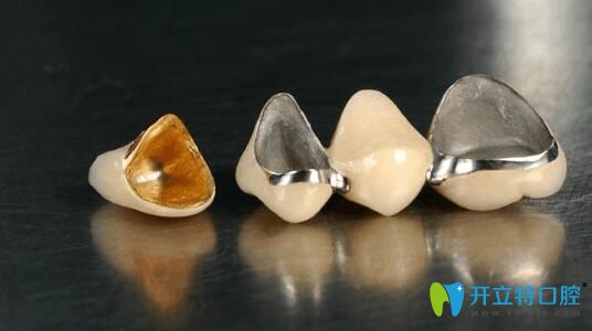 曹振醫(yī)生告訴大家:烤瓷牙有哪些種類和價格各是多少 曹振醫(yī)生告訴大家:烤瓷牙有哪些種類和價格各是多少