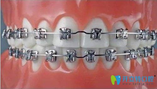 諾德口腔金屬托槽矯正圖片