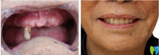 格倫菲爾下頜無牙種植圖