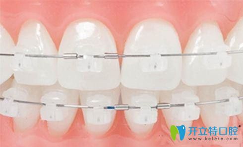 半隱形陶瓷托槽圖片