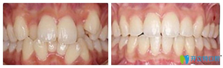 唯美凸嘴牙齒不齊矯正案例圖