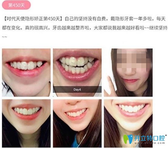 顧客戴時(shí)代天使隱形矯正450天左右圖示