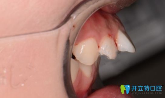 新鄉(xiāng)拜博口腔牙齒正畸術(shù)前側(cè)面照 新鄉(xiāng)拜博口腔牙齒正畸術(shù)前側(cè)面照