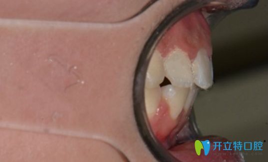 在新鄉(xiāng)拜博口腔做金屬自鎖托槽正畸術(shù)后側(cè)面照 在新鄉(xiāng)拜博口腔做金屬自鎖托槽正畸術(shù)后側(cè)面照