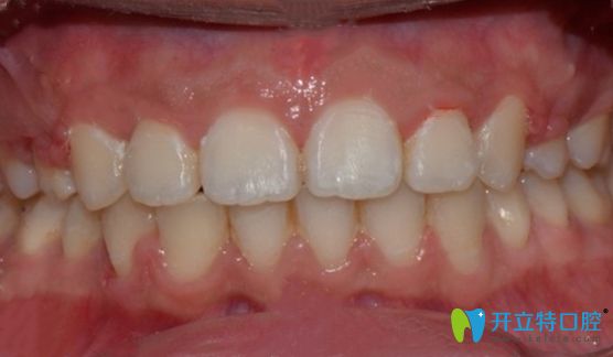 新鄉(xiāng)拜博口腔牙齒矯正術(shù)后正面照 新鄉(xiāng)拜博口腔牙齒矯正術(shù)后正面照