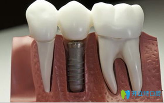 弄清韓國登騰種植牙很差的原因,就明白選登騰種植牙靠譜嗎?