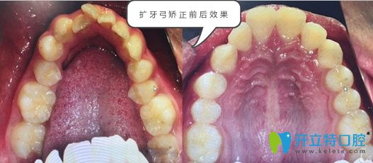 擴弓矯正的前后效果對比圖