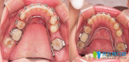 牙齒擴弓矯正后會反彈嗎