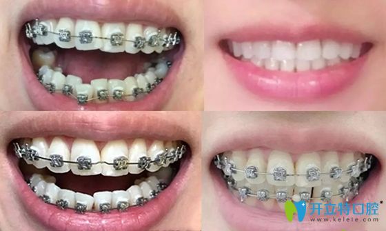 西安畫(huà)美口腔牙齒矯正案例效果圖