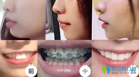 西安藝星口腔科正畸案例效果