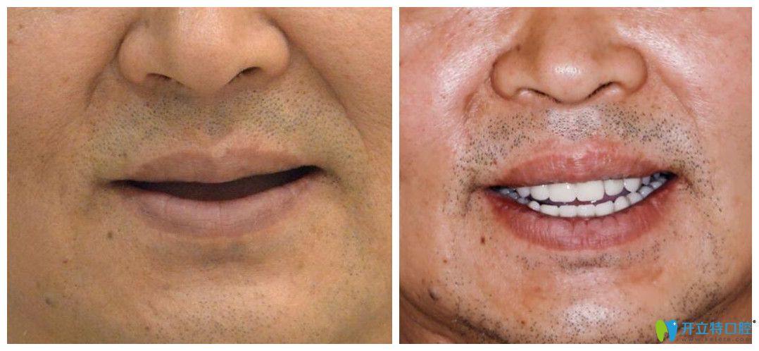 西安中諾口腔立得用種植牙效果