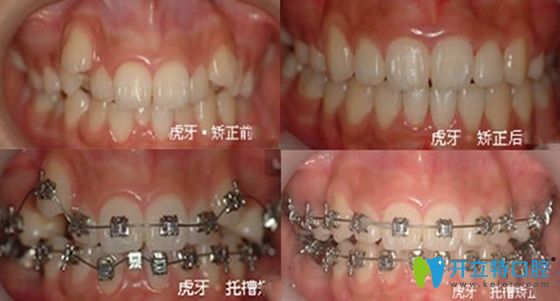 <!--<i data=20240703-sp></i>-->口腔牙齒矯正案例效果