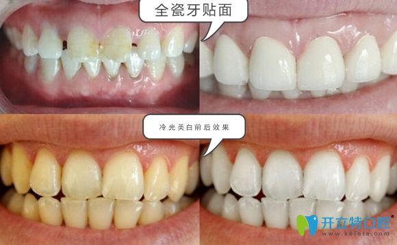 濟(jì)南韓氏口腔全瓷牙貼面和冷光美白效果圖