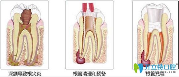 顯微根管治療5000多元!誰能告訴我牙齒根管治療為什么那么貴