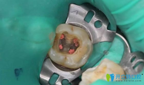 牙齒根管治療過程中圖片