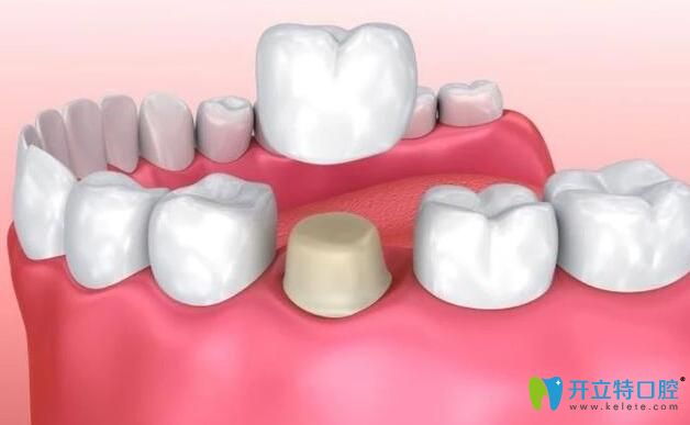 單顆牙畸形7天快速矯正之拔除種植