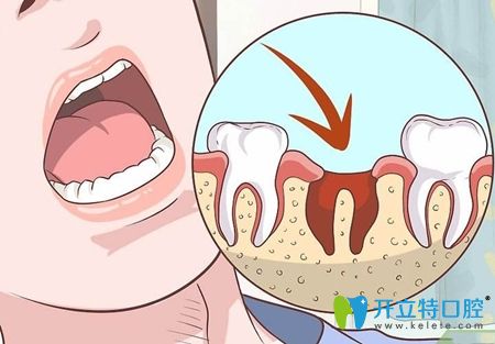 拔牙后要注意口腔護(hù)理