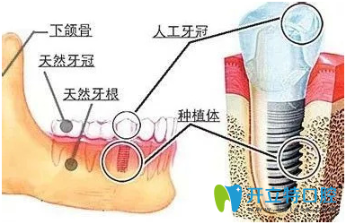 常用的人工種植牙技術有哪些？請看種植牙技術排名	