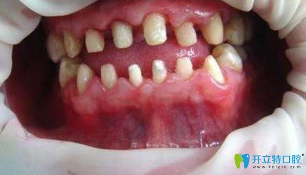 做烤瓷牙牙齒磨小后照片