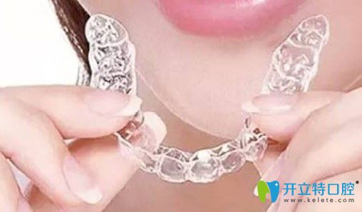 諾德隱形牙套圖