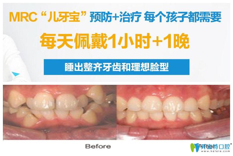 兒童乳牙反頜早期干預矯正案例